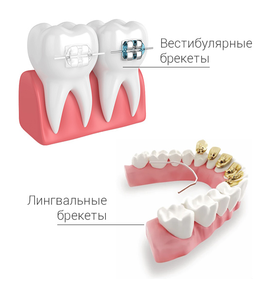 Брекеты в текст.jpg